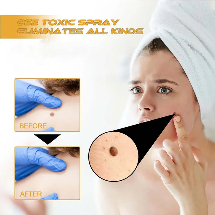 Bee Venom Skin Tag & Wart Remover Spray - Rs.999/-