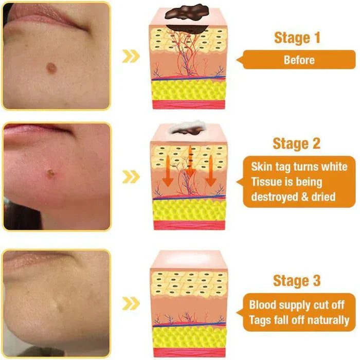 Bee Venom Skin Tag & Wart Remover Spray - Rs.999/-